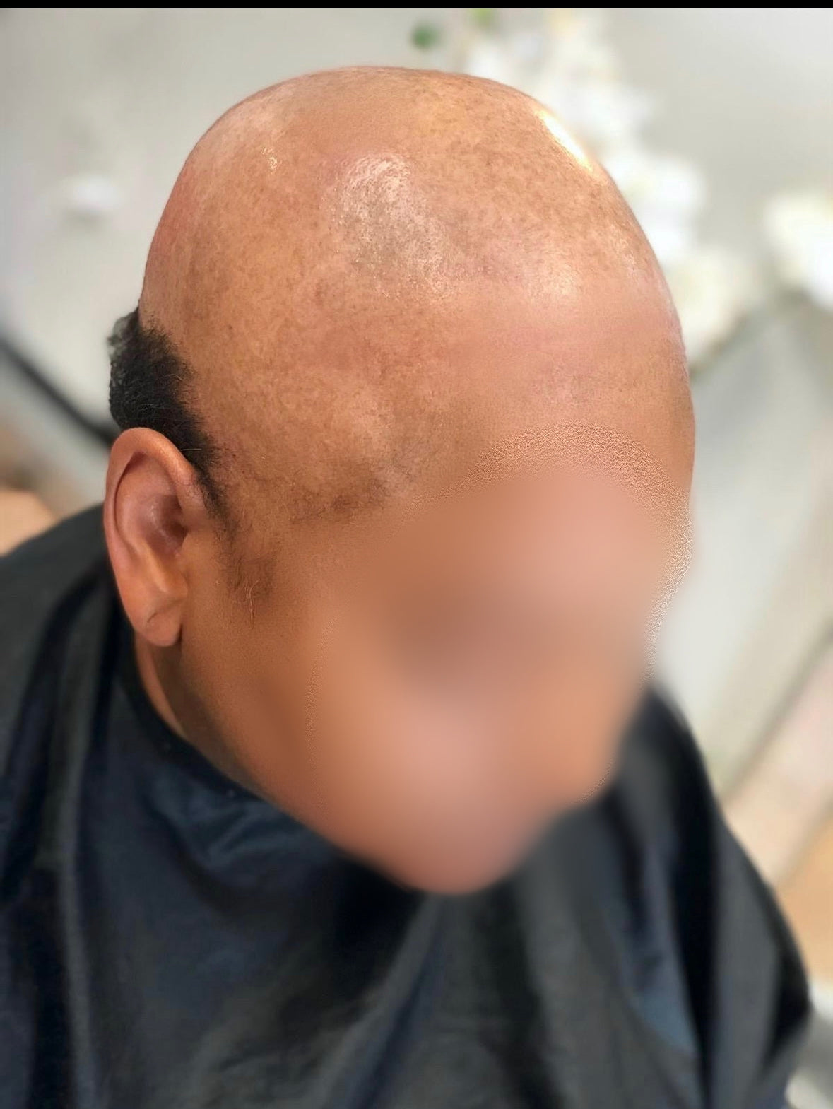 TruNu Scalp By Christina Benjamin “Perfect Pixie” Crown Topper